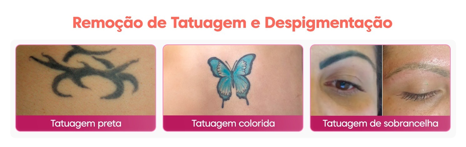 Croma Beauty Laser para Remoção de Tatuagem Despigmentação e Black